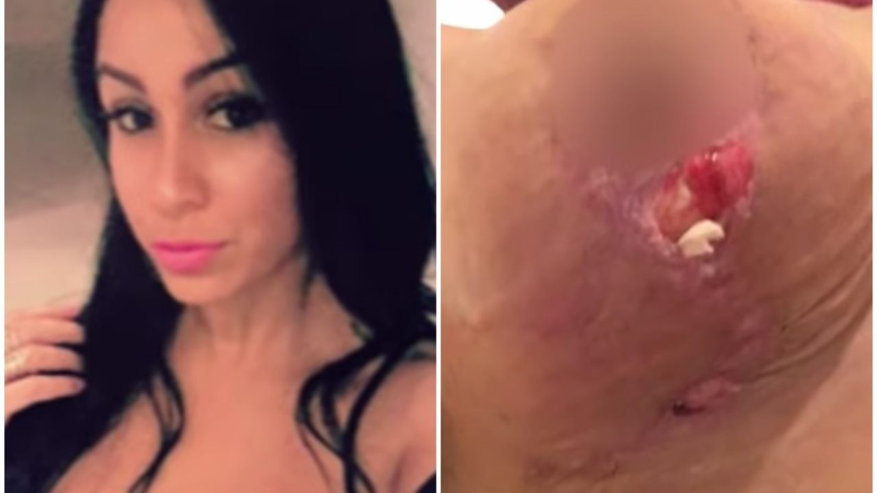 Woman's Breast Implants Falls Out Of Open Wounds Post Surgery • Hollywood  Unlocked