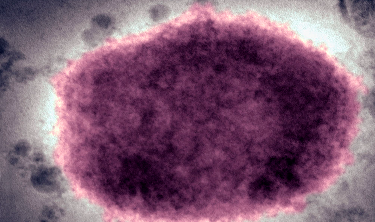 monkeypox case reported in massachusetts