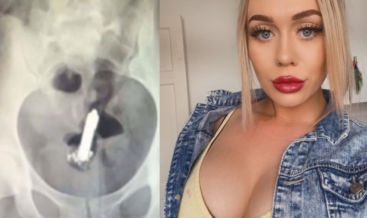 vibrator removed from tiktokers butt