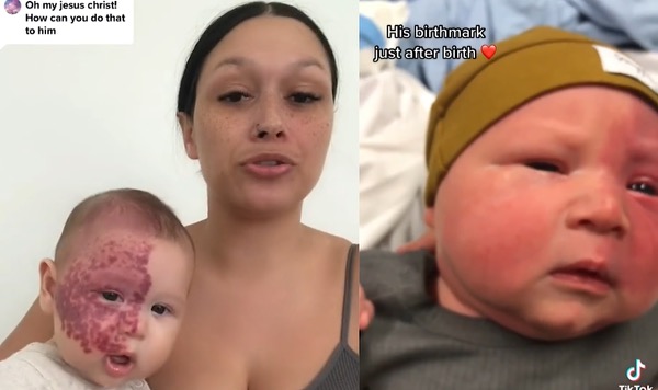 Australian Mother Labeled A 'Monster' After Removing Newborn's Facial Birthmark With Laser