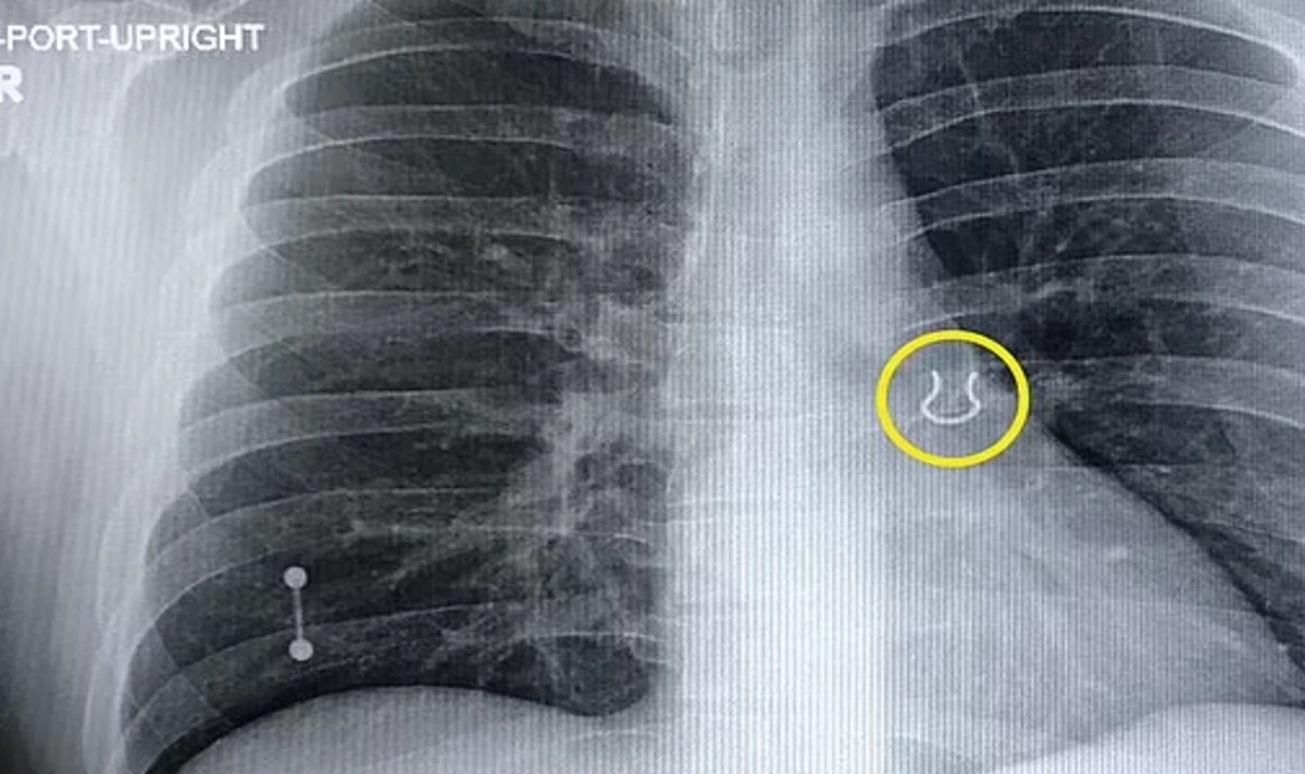 doctor removes nose from lung