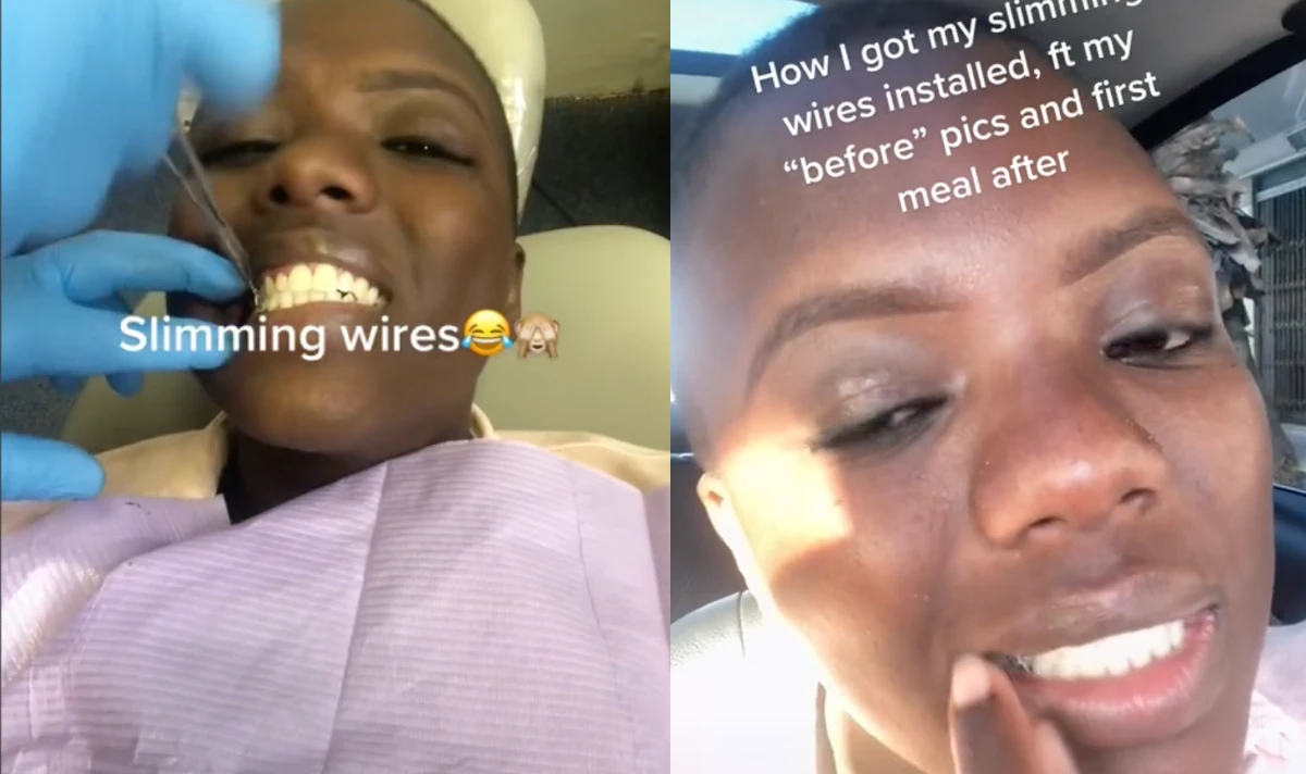 Woman Wires Her Mouth Shut To Reportedly Lose Weight Hollywood Unlocked