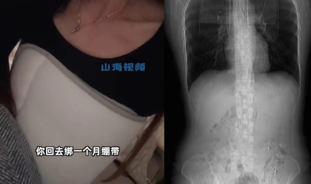 Ouch! Woman Breaks Her Ribs While Coughing After Eating Spicy Food