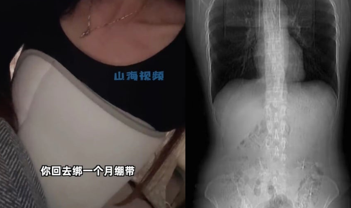 Woman breaks ribs after coughing