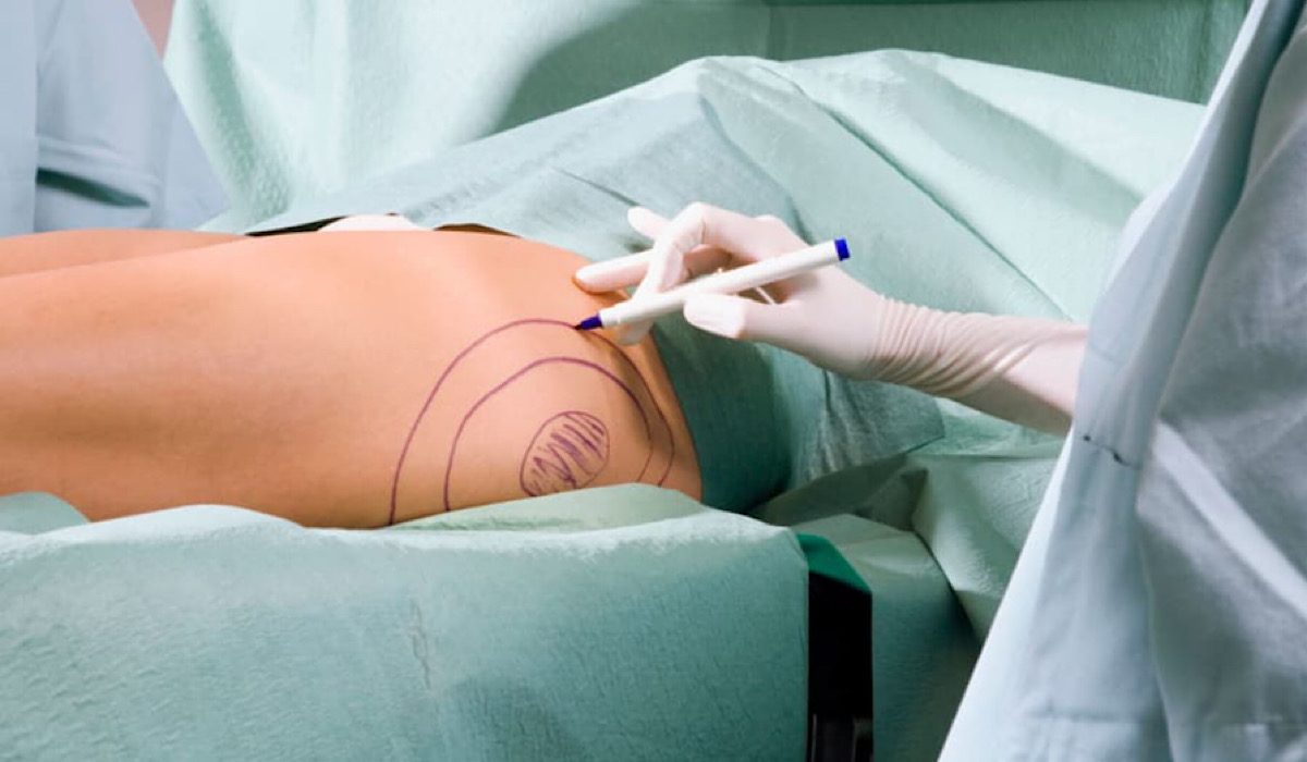 New York Doctor Says Women Are Lining Up To Pay $25,000 To Have Their Brazilian Butt Lift Fat Sucked Out