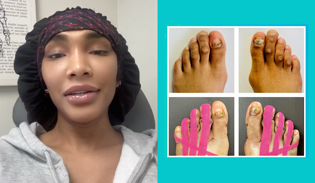 Foot Surgery To Remove Corns Bunions