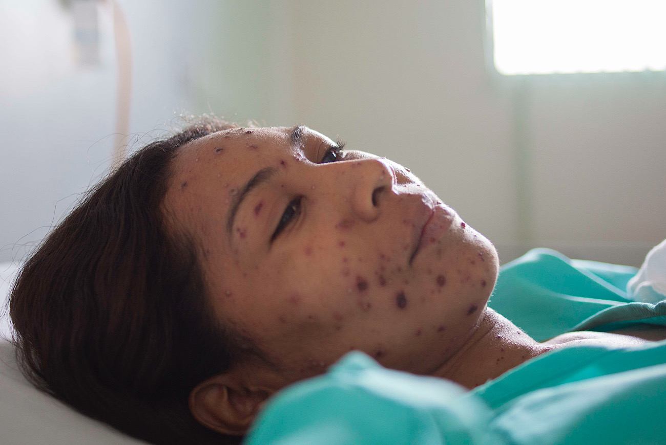 U.S. Ends 2025 With Over 2,065 Confirmed Measles Cases, CDC Says It’s The Highest In 30 Years; Texas, Arizona, South Carolina, Utah Lead With Most Cases