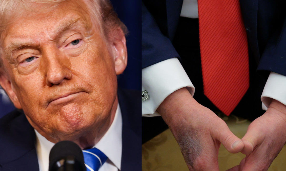 Donald Trump Blames Hand Bruises On Aspirin; Brushes Off Health Concerns And Denies Sleeping In Public