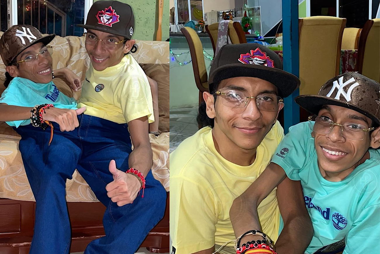 Conjoined Twin Influencers José Luis And José Armando Cevallos Pass Away At 27 After One Has Heart Attack